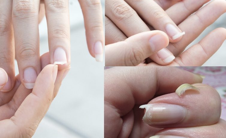 Check your nails right away if you have these symptoms you may have a very serious illness