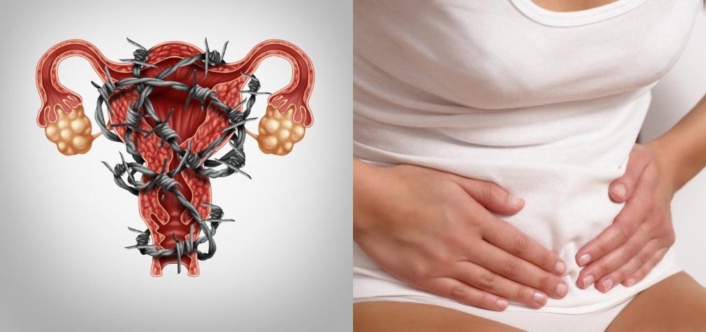 Endometriosis Causes Symptoms Diagnosis and Treatment