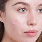 Herbal Treatment of Skin Spots, Natural Remedy