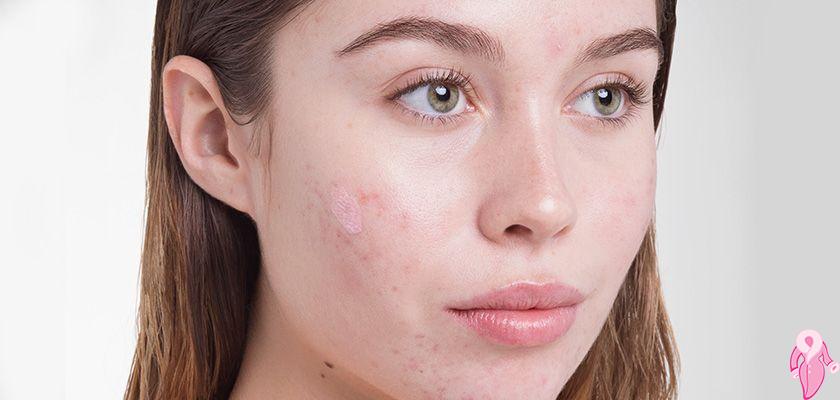 Herbal Treatment of Skin Spots Natural Remedy