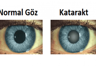 What are the Symptoms of Cataract, How to Understand?  Treatment