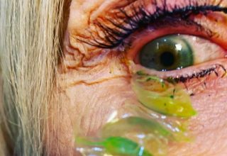 What happens if you dont remove the lens from your eye A woman did this for 23 days the result is shocking