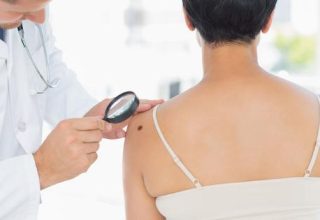 What is Malignant Melanoma, Its Symptoms and Stages?