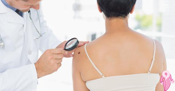 What is Malignant Melanoma Its Symptoms and Stages