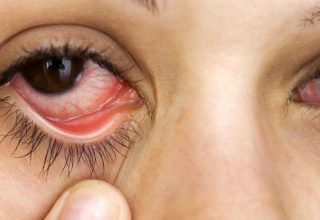 Herbal Treatment of Dry Eyes, Natural Remedy