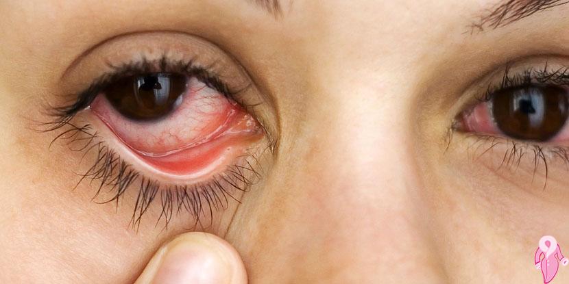 Herbal Treatment of Dry Eyes Natural Remedy