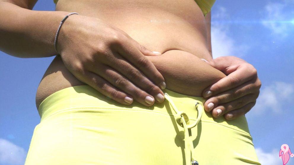 How to Melt the Sagging Belly Postpartum