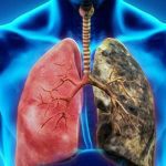 What are the first symptoms of lung cancer, how to understand?