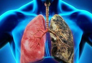 What are the first symptoms of lung cancer, how to understand?