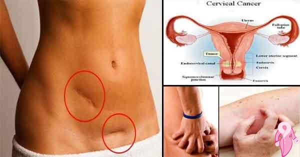 What are the Symptoms of Cervical Cancer