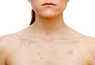 How Do Decollete Pimples Pass?