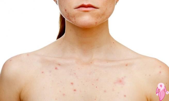 How Do Decollete Pimples Pass