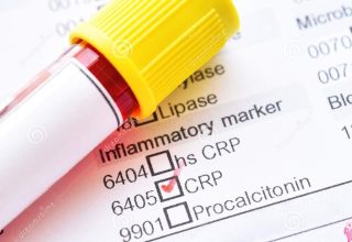 What are the Causes of High CRP?  How to Lower the CRP Level in the Blood?