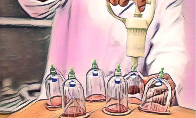 What is Cupping Therapy Heres Everything You Need To Know