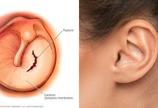 How Does Eardrum Perforation Happen?  How does it go?