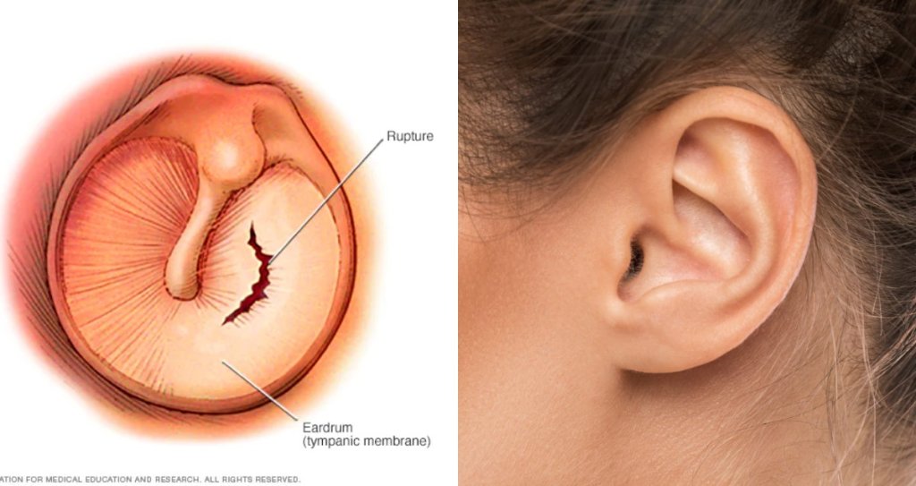 How Does Eardrum Perforation Happen How does it go