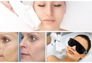 Laser Skin Resurfacing: The 8 Most Important Things You Should Know
