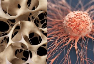 The Relationship Between Osteoporosis and Cancer