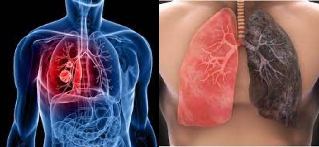 What You Should Know About Lung Cancer
